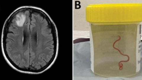 Combo de imágenes de una resonancia magnética del cerebro de una mujer del que se extrajo una lombriz de pitón, de 8 centímetros de largo.