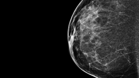 Fotografía referencial de una mamografía de un seno derecho.