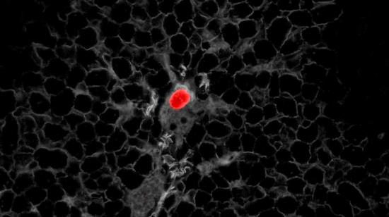 Identificación microscópica de la célula tumoral de un paciente con cáncer de colon. 