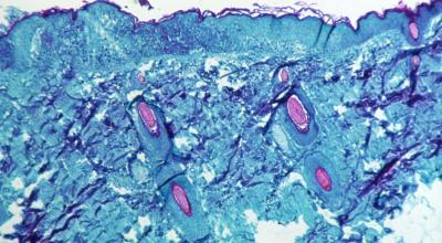 Imagen microscópica de una parte de la piel contagiada con la viruela del mono. 